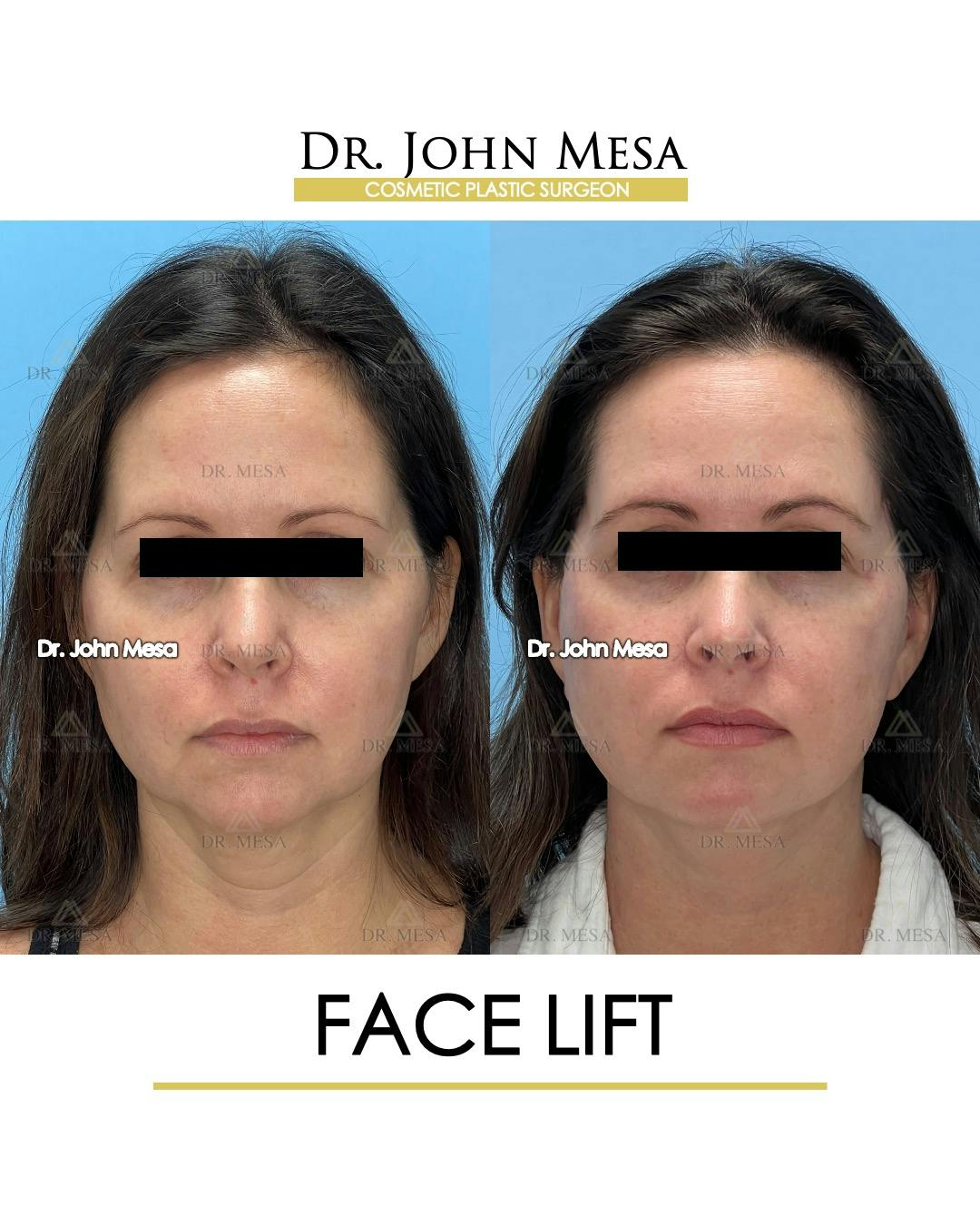 Facelift Before & After Gallery - Patient 149097991 - Image 1