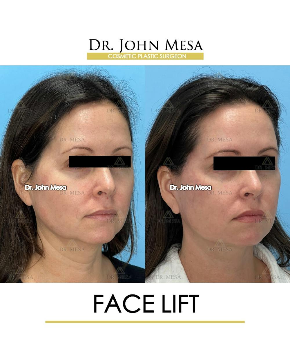 Facelift Before & After Gallery - Patient 149097991 - Image 2