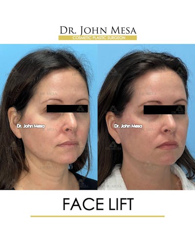 Facelift Before & After Gallery - Patient 149097991 - Image 2
