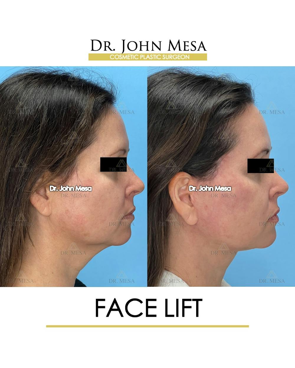 Facelift Before & After Gallery - Patient 149097991 - Image 3
