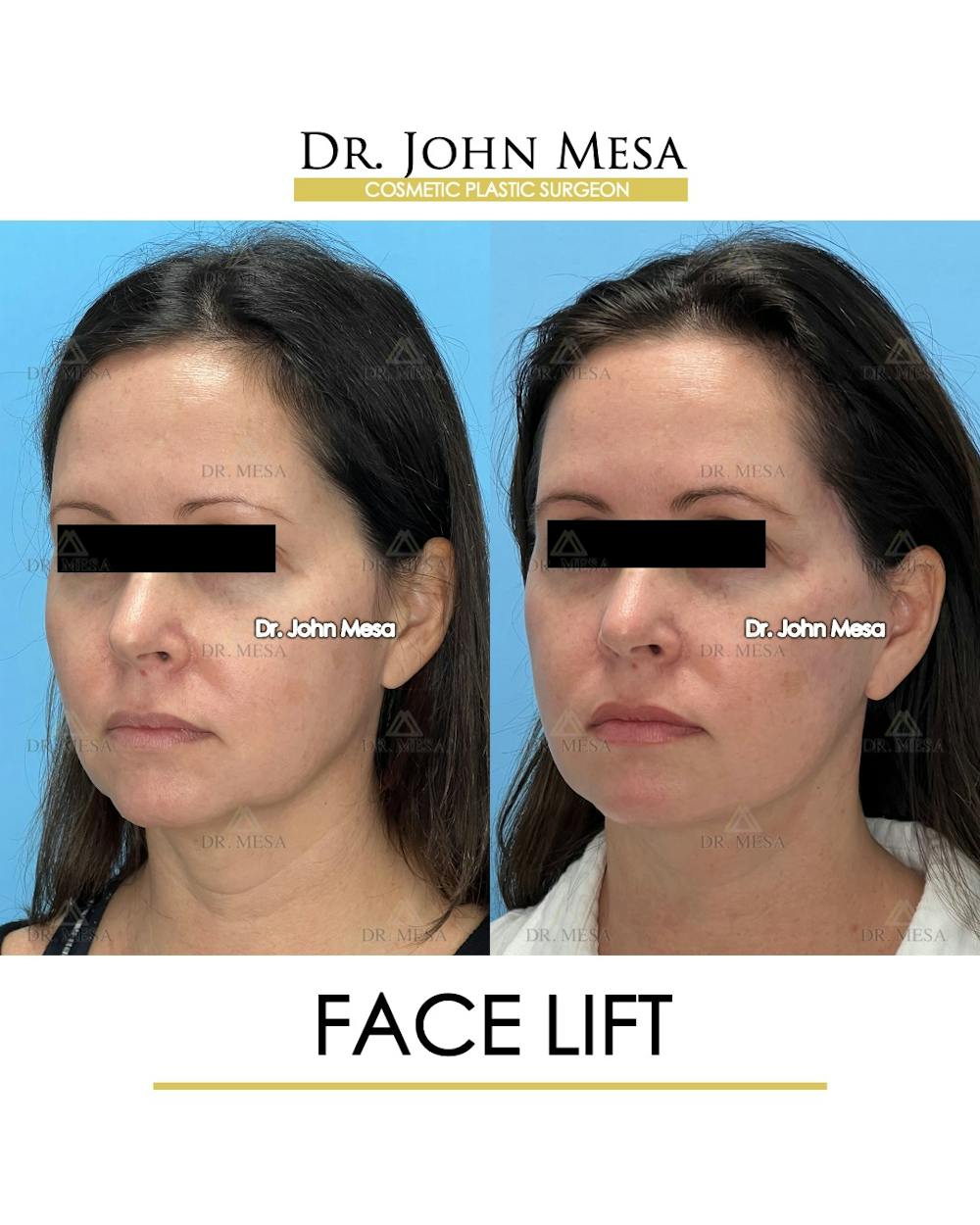 Facelift Before & After Gallery - Patient 149097991 - Image 4