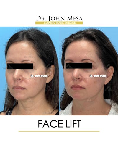 Facelift Before & After Gallery - Patient 149097991 - Image 4