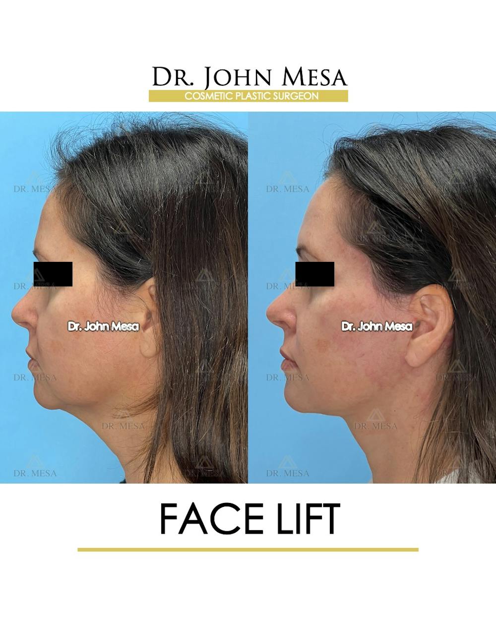 Facelift Before & After Gallery - Patient 149097991 - Image 5