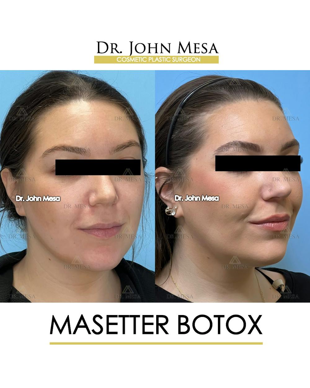 BOTOX Before & After Gallery - Patient 149097994 - Image 2