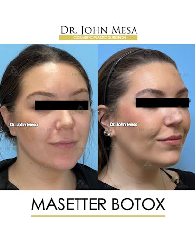 BOTOX Before & After Gallery - Patient 149097994 - Image 2
