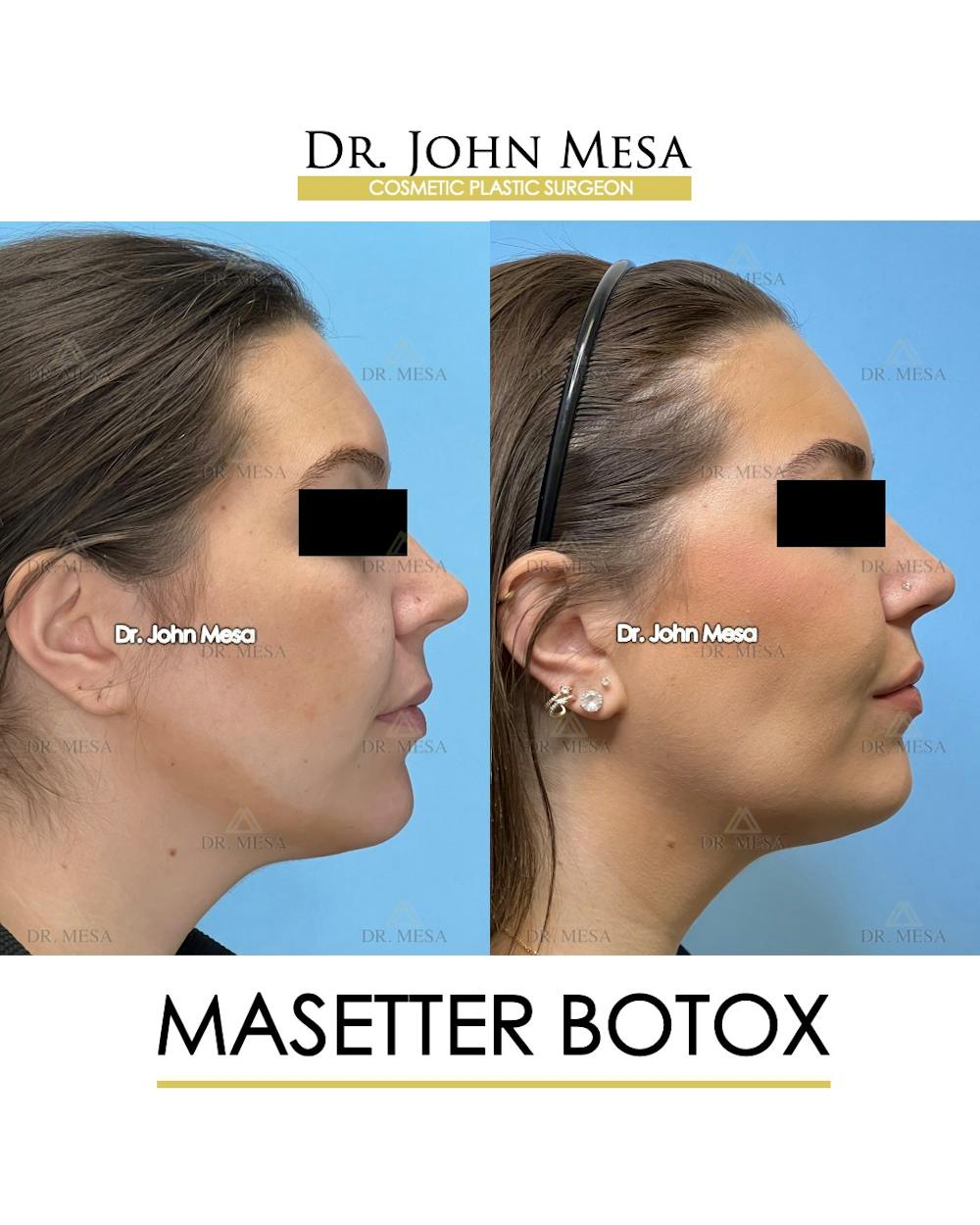Botox Before & After Gallery - Patient 149097994 - Image 3