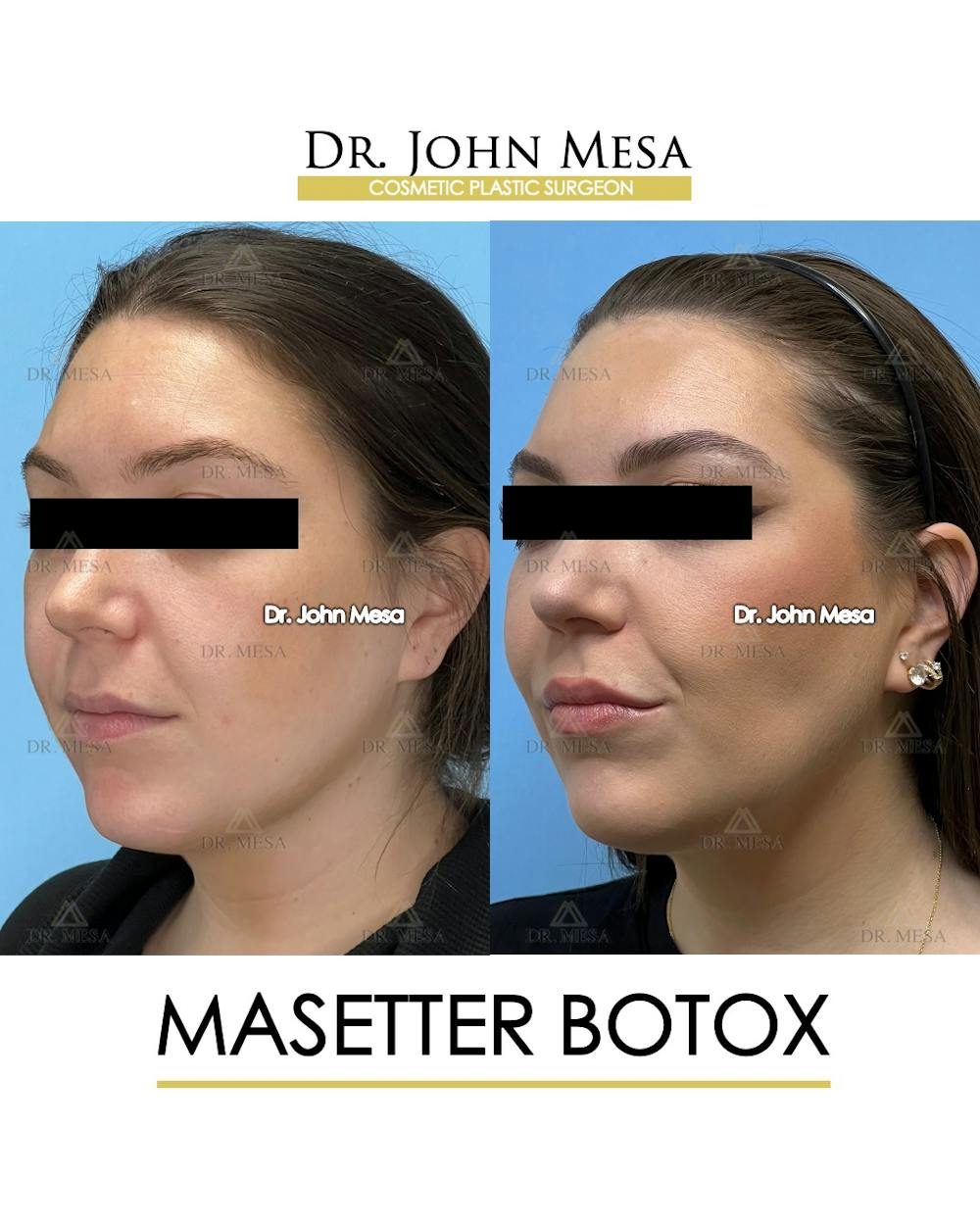 Botox Before & After Gallery - Patient 149097994 - Image 4