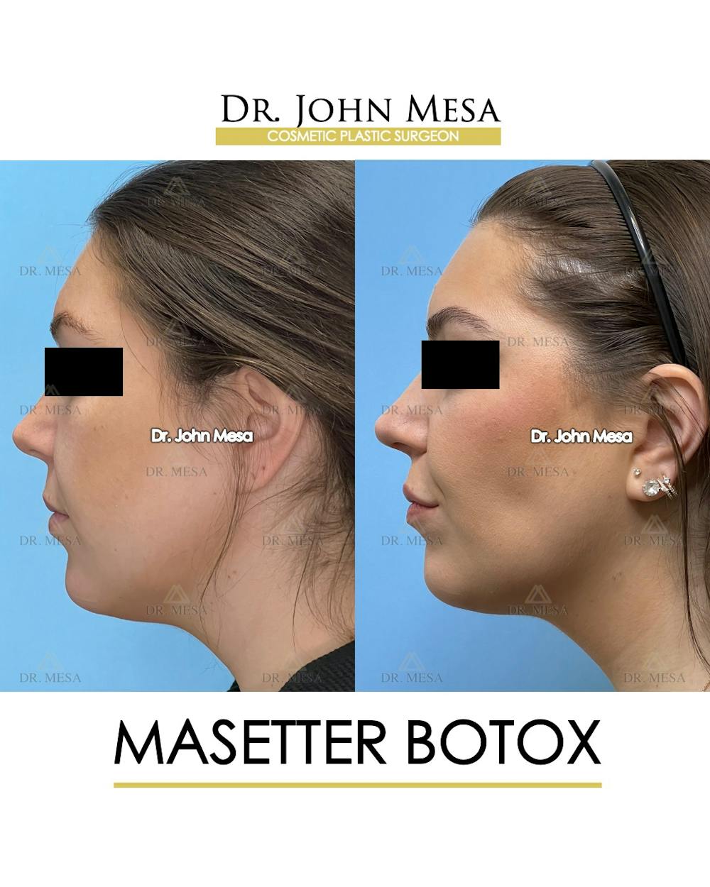 Botox Before & After Gallery - Patient 149097994 - Image 5