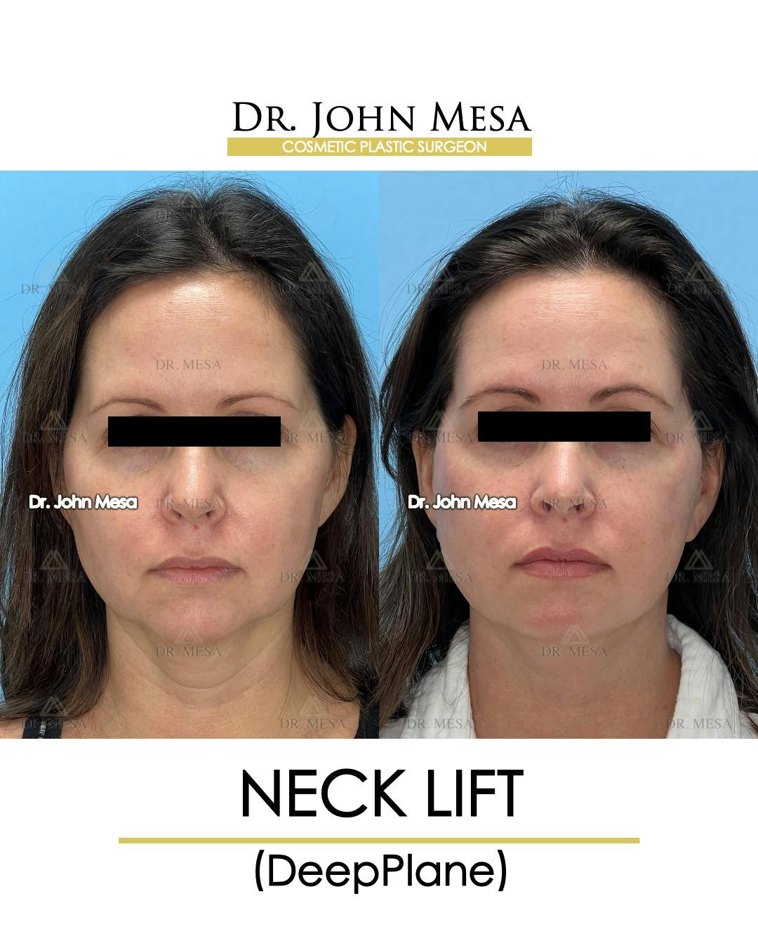 Neck Lift Before & After Gallery - Patient 149097995 - Image 1
