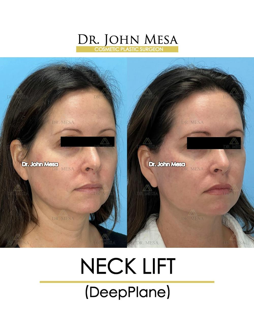 Neck Lift Before & After Gallery - Patient 149097995 - Image 2