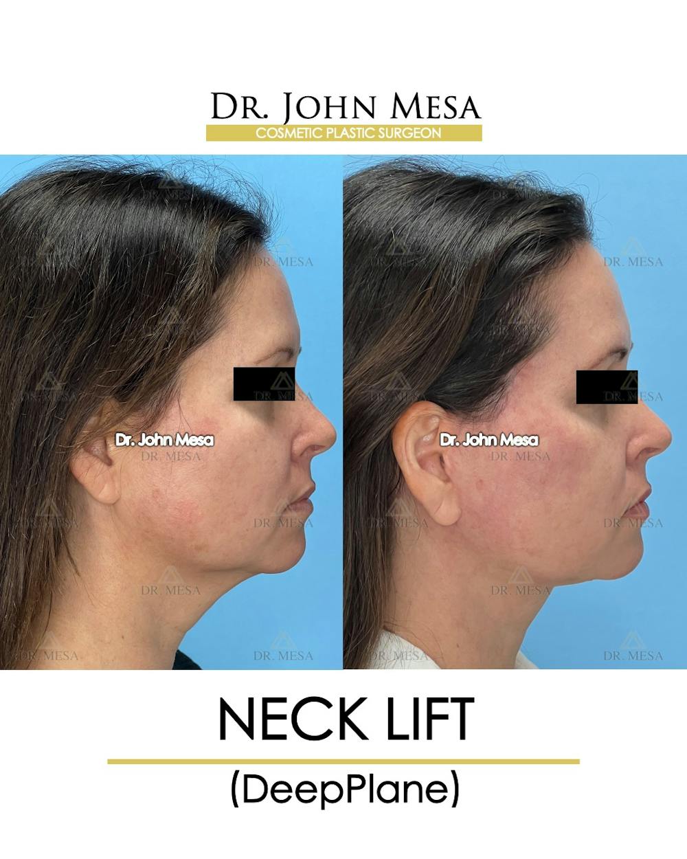 Neck Lift Before & After Gallery - Patient 149097995 - Image 3