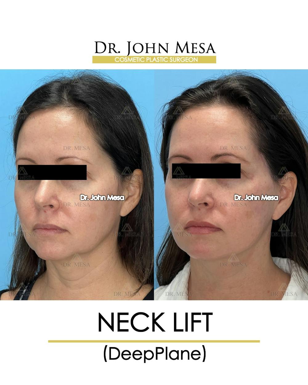 Neck Lift Before & After Gallery - Patient 149097995 - Image 4
