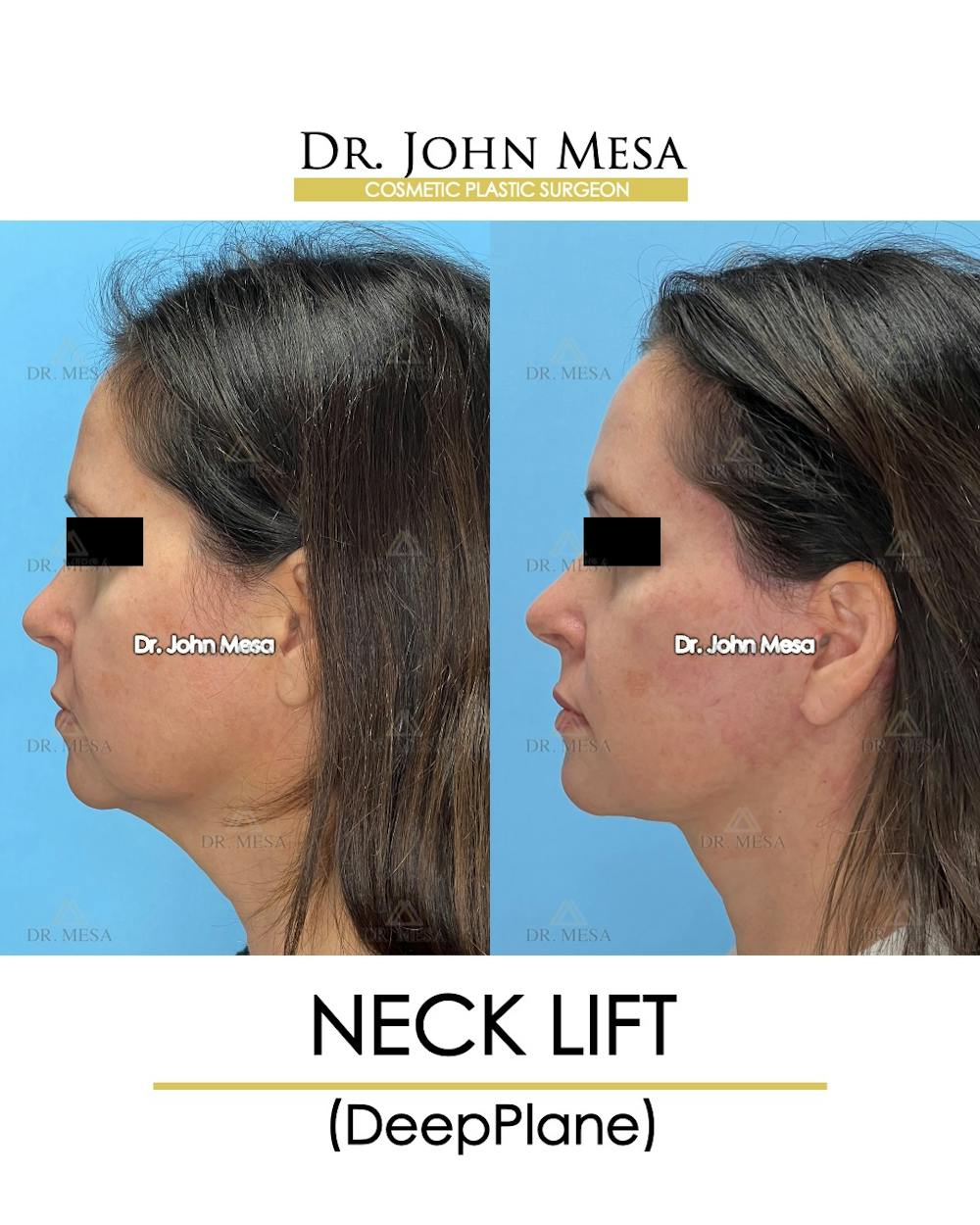 Neck Lift Before & After Gallery - Patient 149097995 - Image 5