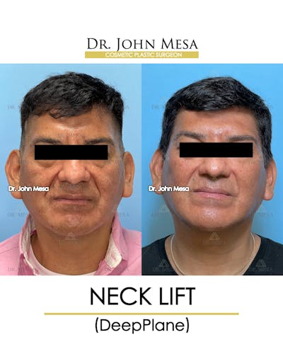 Neck Lift Before & After Gallery - Patient 149098012 - Image 1