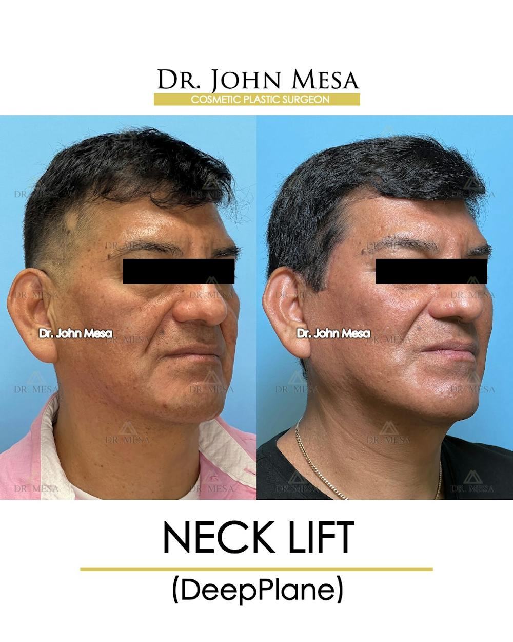 Neck Lift Before & After Gallery - Patient 149098012 - Image 2