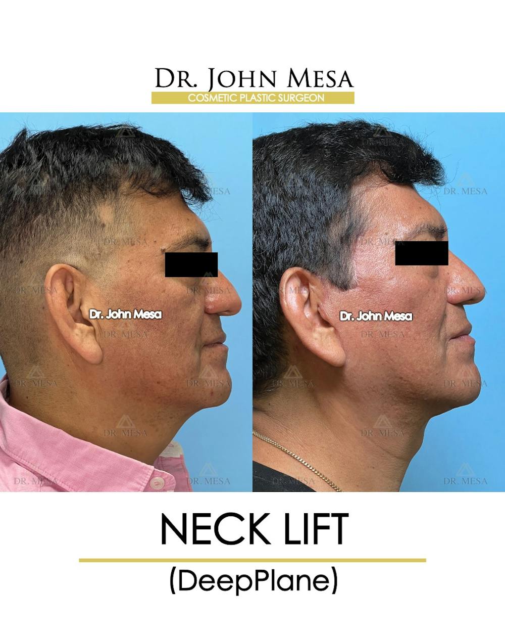 Neck Lift Before & After Gallery - Patient 149098012 - Image 3
