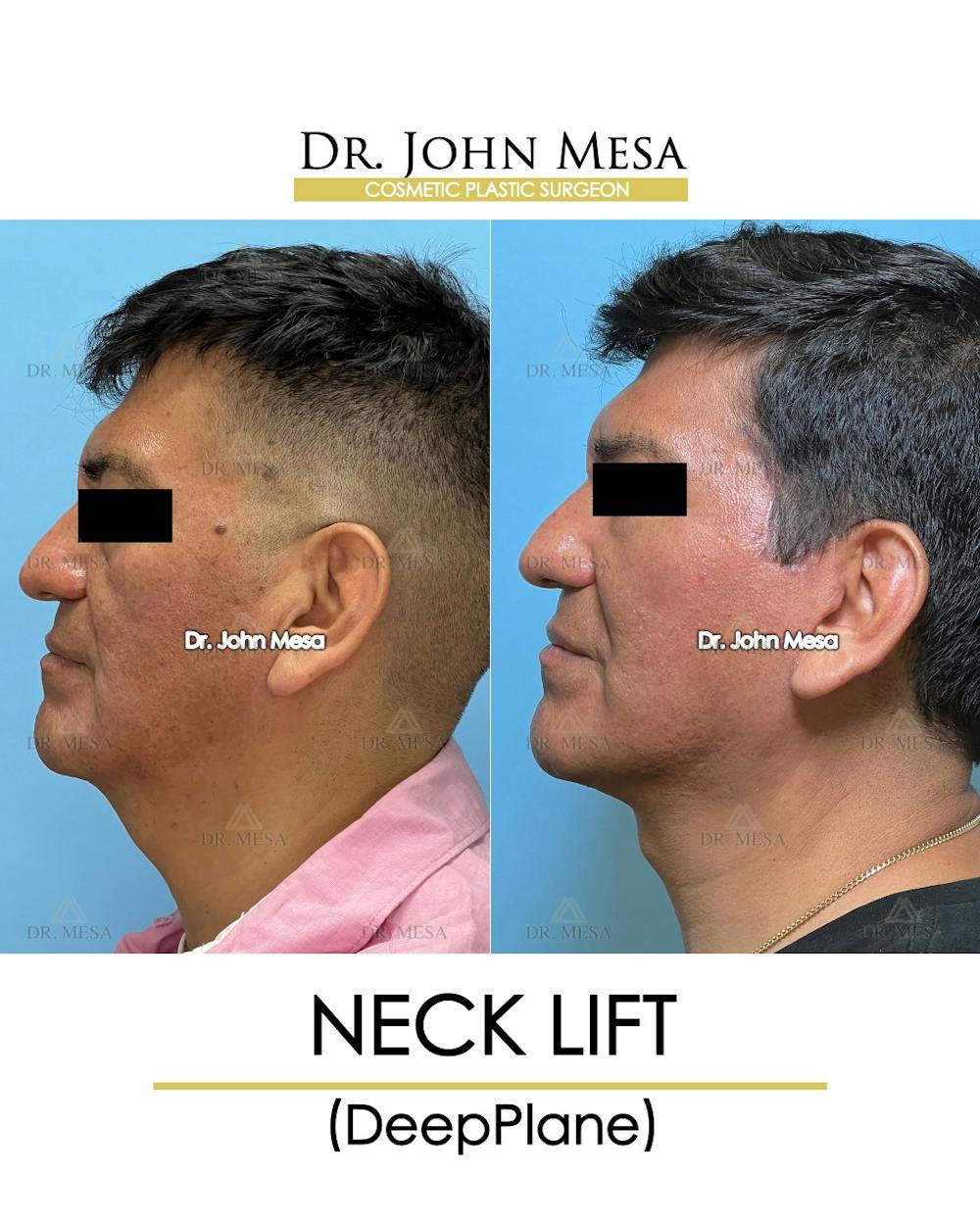 Neck Lift Before & After Gallery - Patient 149098012 - Image 5