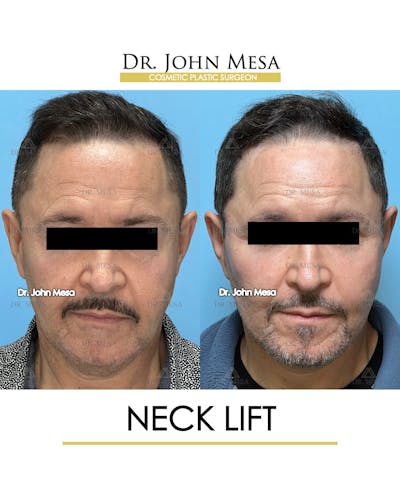 Neck Lift Before & After Gallery - Patient 149098011 - Image 1