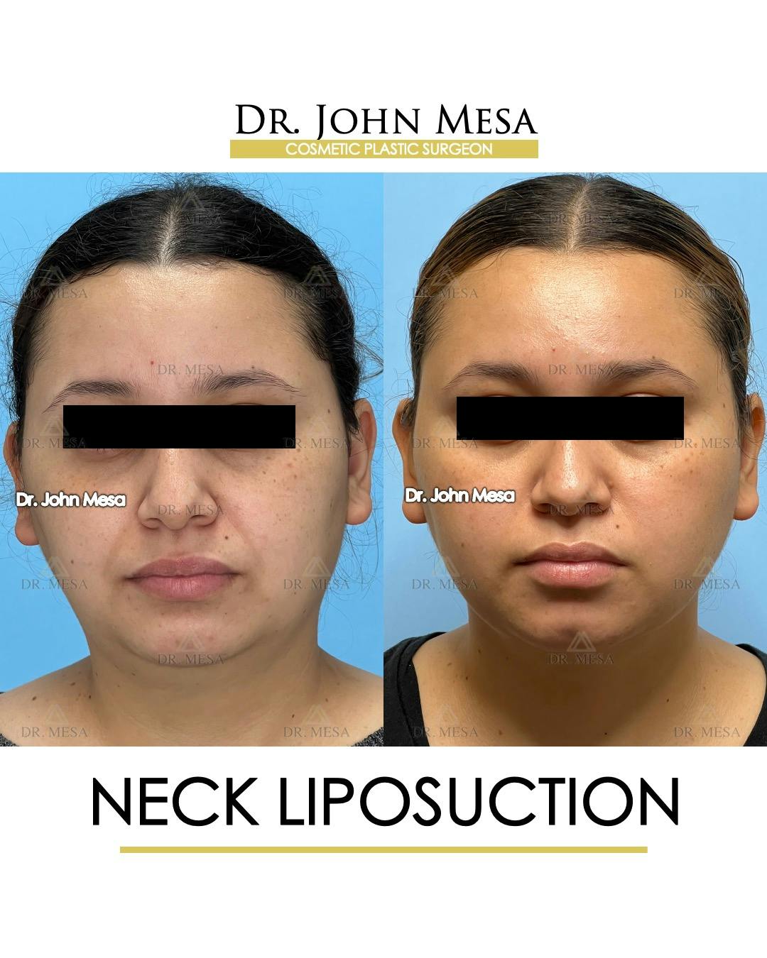 Neck Liposuction Before & After Gallery - Patient 149098013 - Image 1