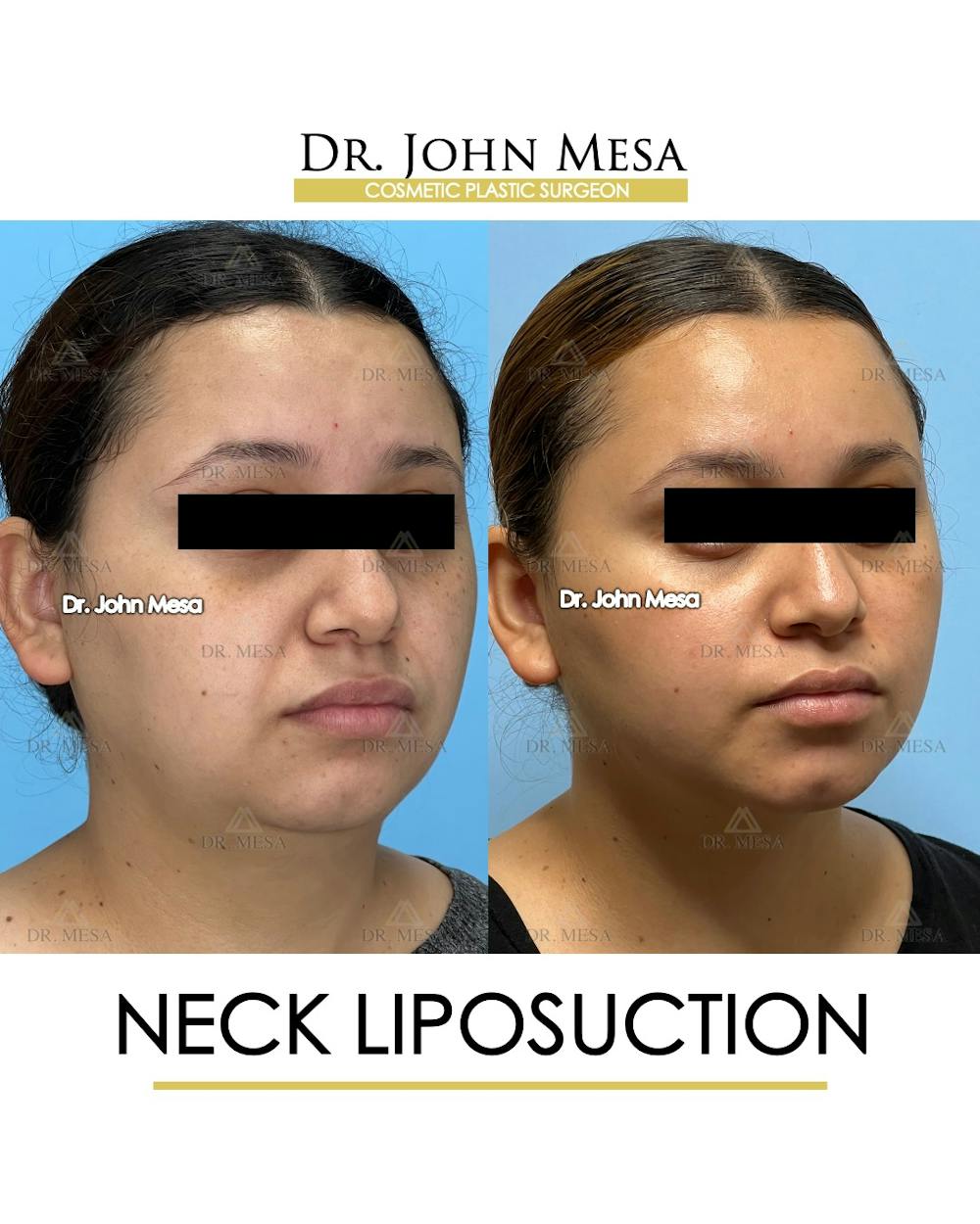 Neck Liposuction Before & After Gallery - Patient 149098013 - Image 2