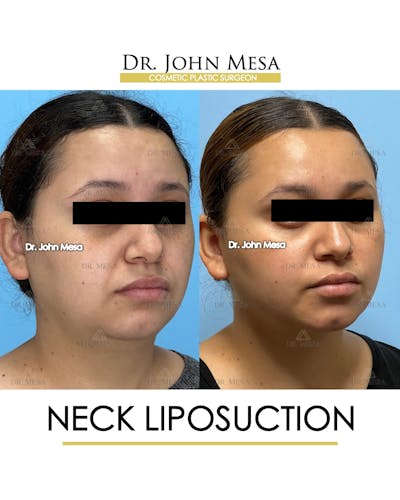 Neck Liposuction Before & After Gallery - Patient 149098013 - Image 2