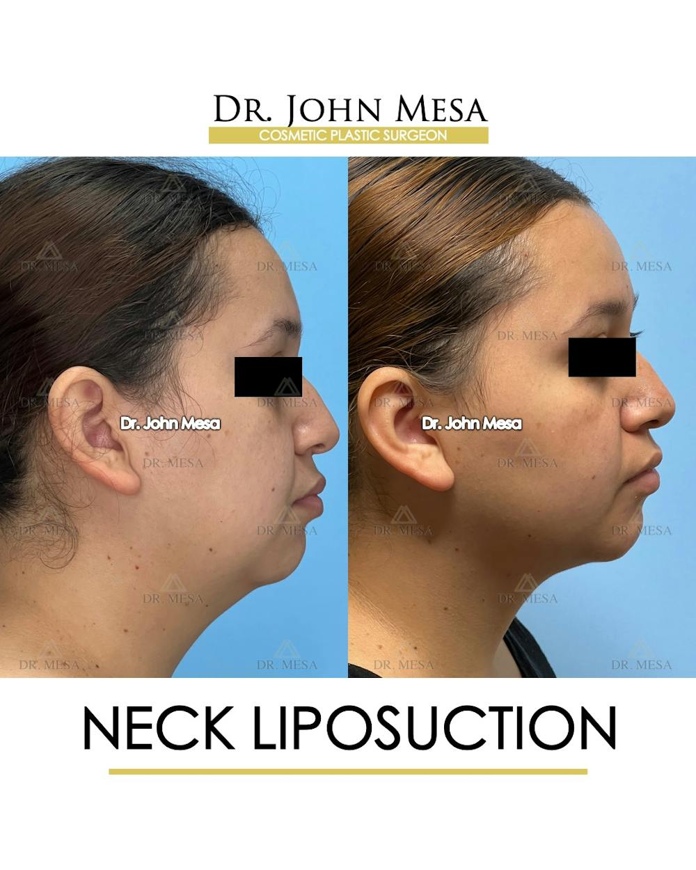 Neck Liposuction Before & After Gallery - Patient 149098013 - Image 3