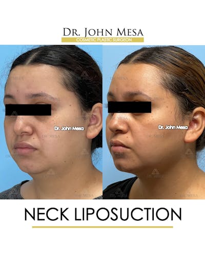 Neck Liposuction Before & After Gallery - Patient 149098013 - Image 4