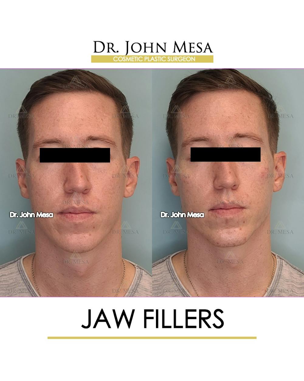 Jaw Filler Before & After Gallery - Patient 149284324 - Image 1