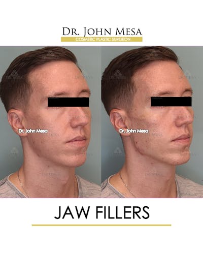 Jaw Filler Before & After Gallery - Patient 149284324 - Image 2