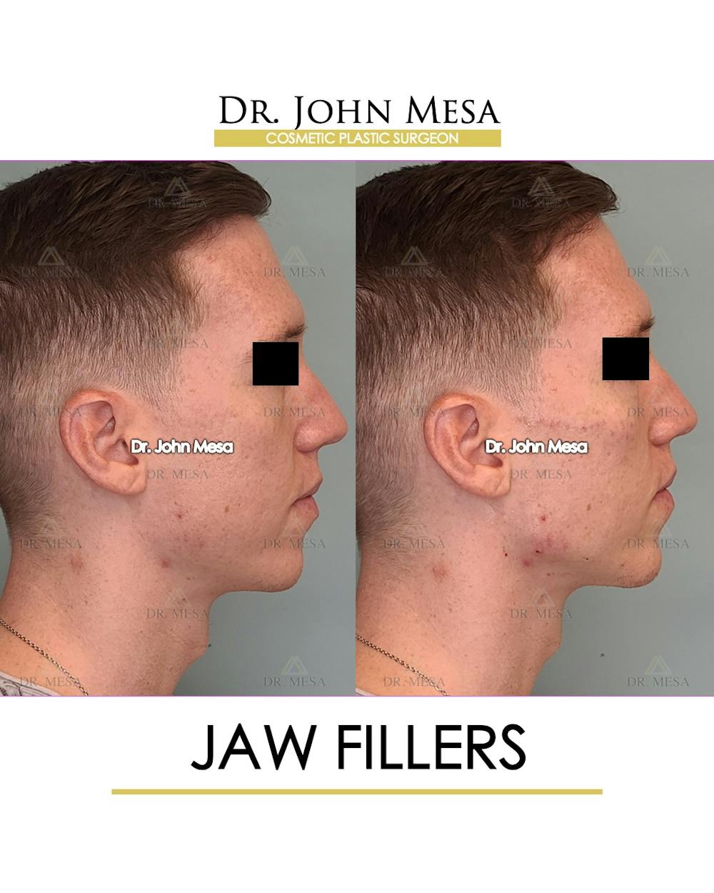 Jaw Filler Before & After Gallery - Patient 149284324 - Image 3