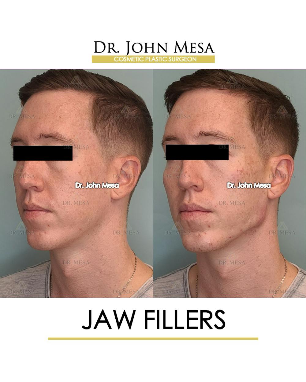 Jaw Filler Before & After Gallery - Patient 149284324 - Image 4