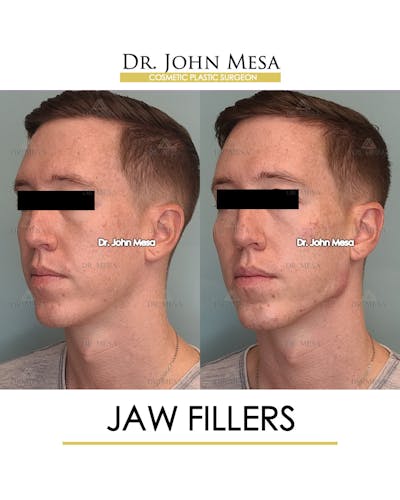 Jaw Filler Before & After Gallery - Patient 149284324 - Image 4