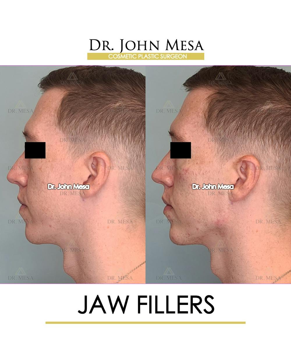 Jaw Filler Before & After Gallery - Patient 149284324 - Image 5