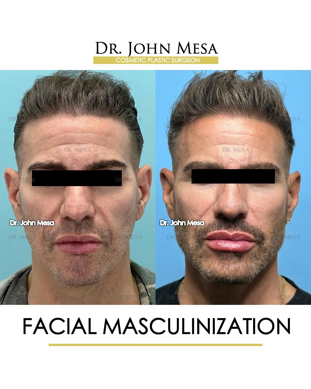 Facial Masculinization Before & After Gallery - Patient 149284326 - Image 1