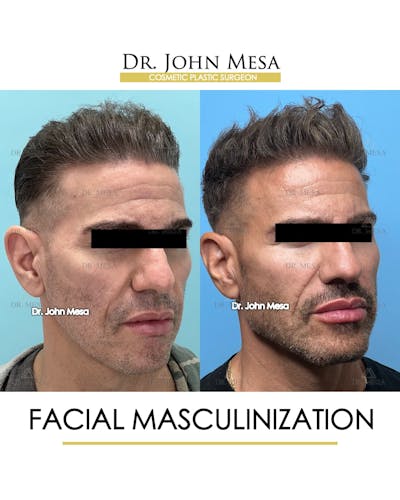 Facial Masculinization Before & After Gallery - Patient 149284326 - Image 2