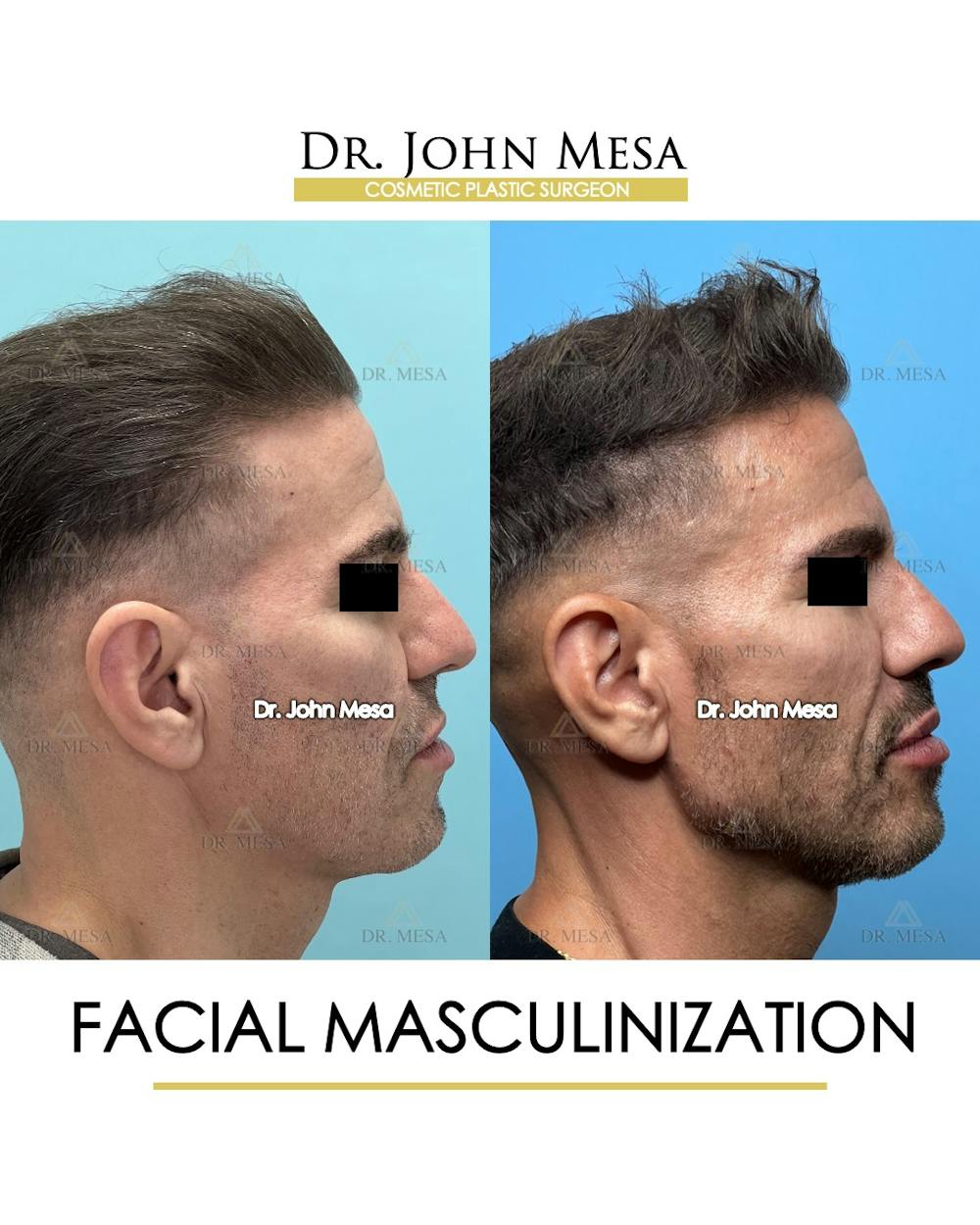Facial Masculinization Before & After Gallery - Patient 149284326 - Image 3