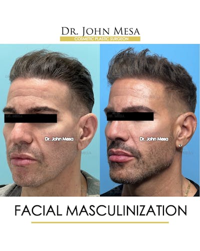 Facial Masculinization Before & After Gallery - Patient 149284326 - Image 4