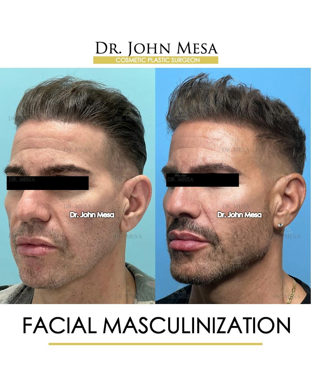 Facial Masculinization Before & After Gallery - Patient 149284326 - Image 4