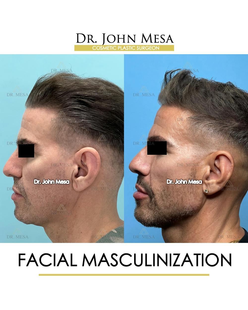 Facial Masculinization Before & After Gallery - Patient 149284326 - Image 5