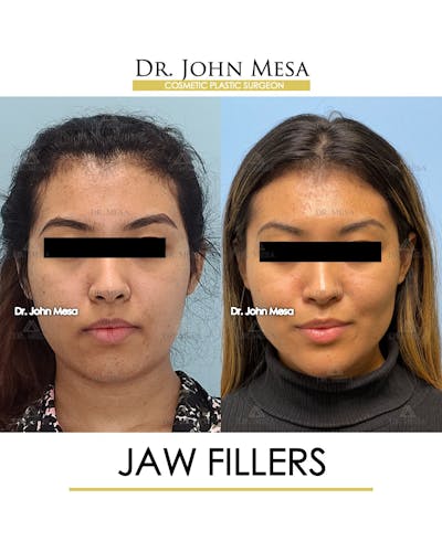 Jaw Filler Before & After Gallery - Patient 149297343 - Image 1