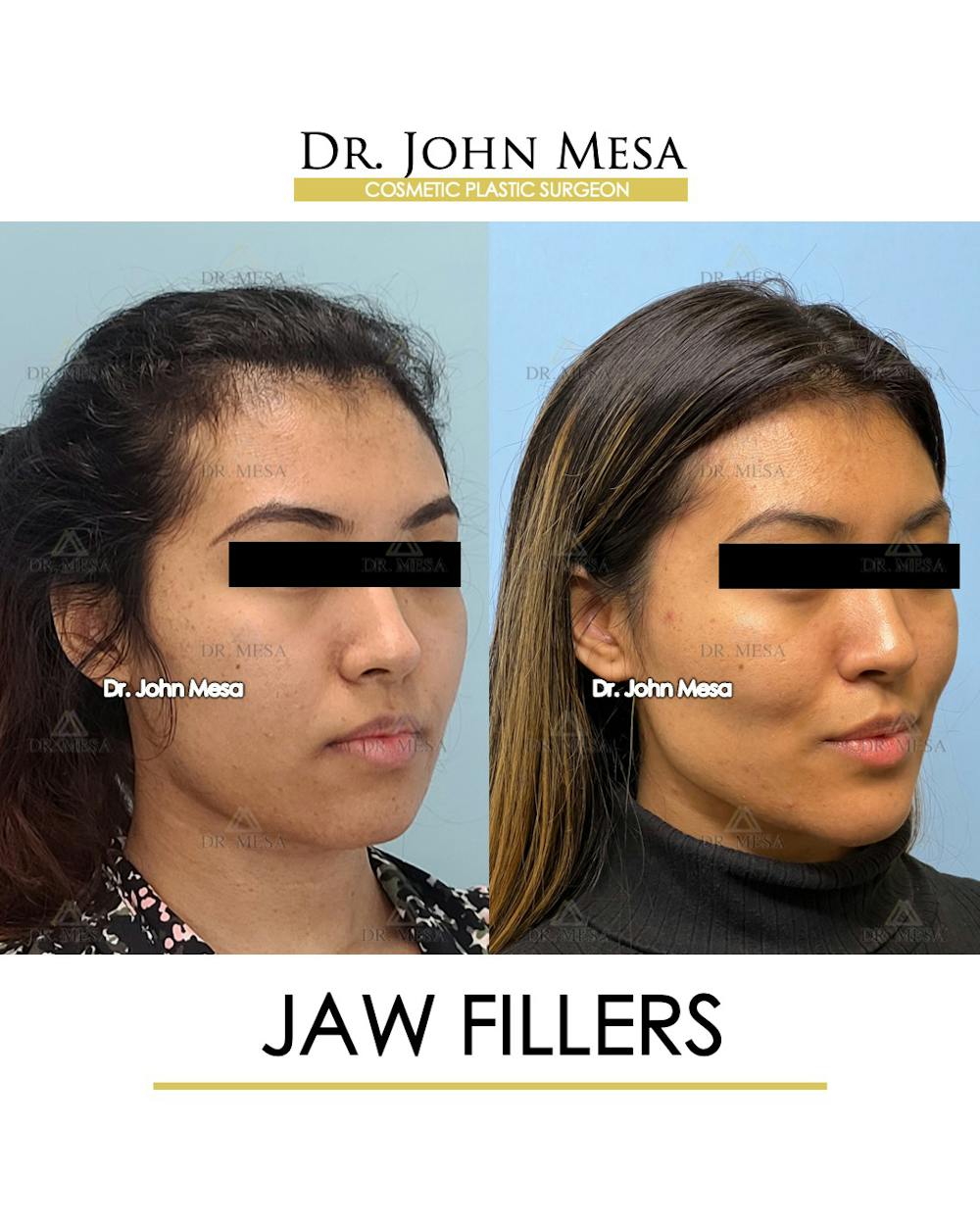 Jaw Filler Before & After Gallery - Patient 149297343 - Image 2