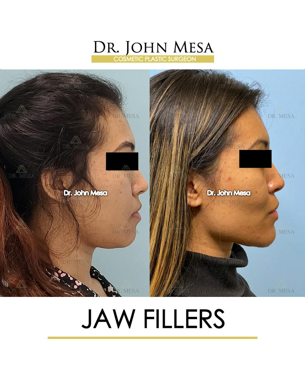 Jaw Filler Before & After Gallery - Patient 149297343 - Image 3