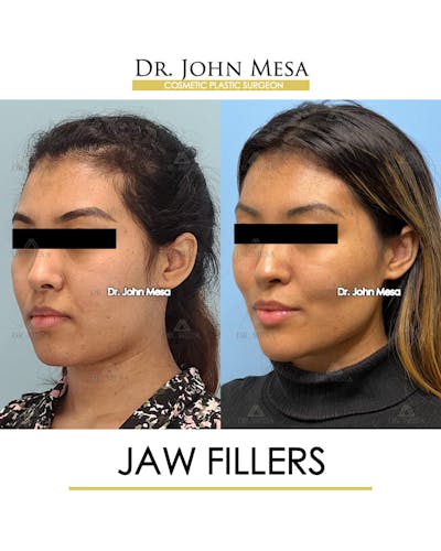Jaw Filler Before & After Gallery - Patient 149297343 - Image 4