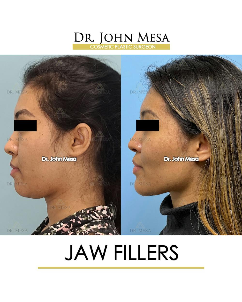 Jaw Filler Before & After Gallery - Patient 149297343 - Image 5