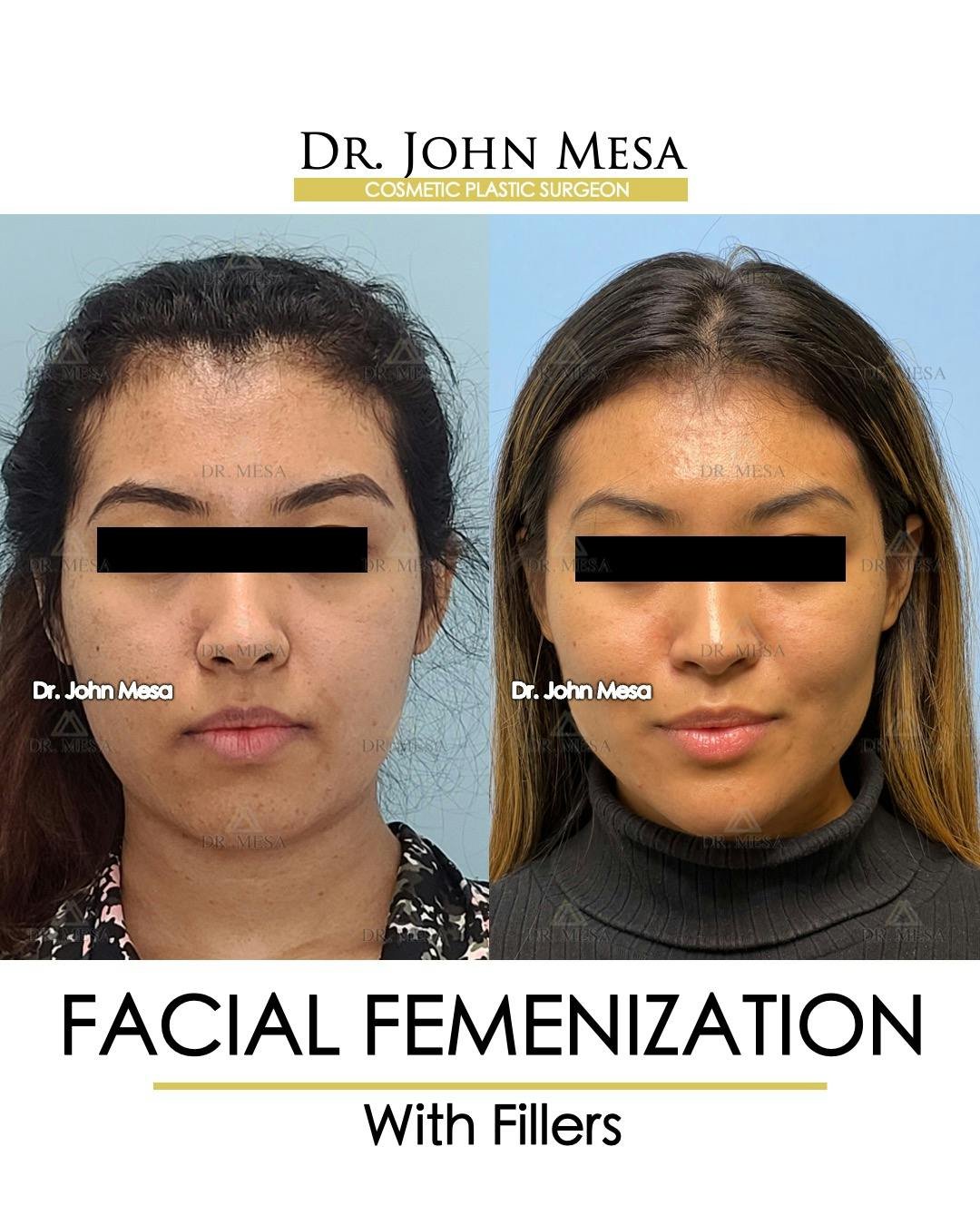 Facial Feminization Before & After Gallery - Patient 148316724 - Image 1