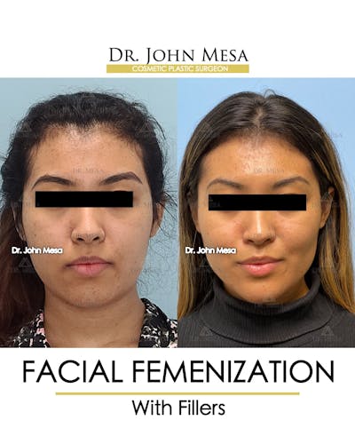 Facial Feminization Before & After Gallery - Patient 148316724 - Image 1