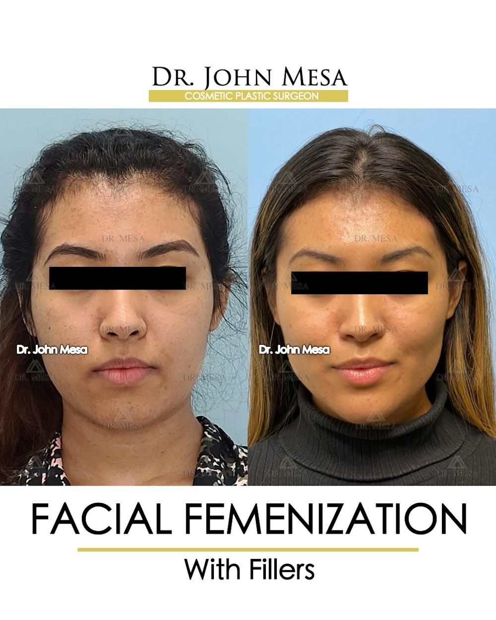 Facial Feminization Before & After Gallery - Patient 148316724 - Image 1