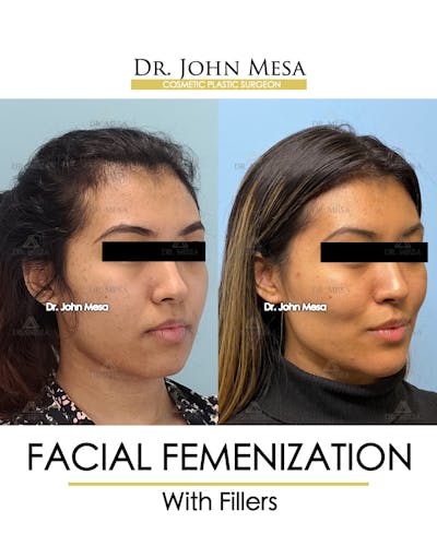 Facial Feminization Before & After Gallery - Patient 148316724 - Image 2