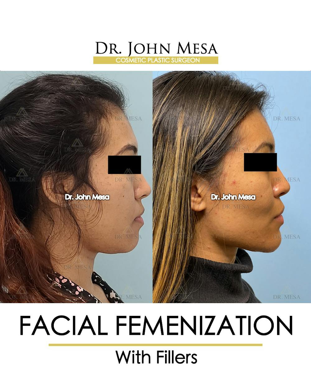 Facial Feminization Before & After Gallery - Patient 148316724 - Image 3