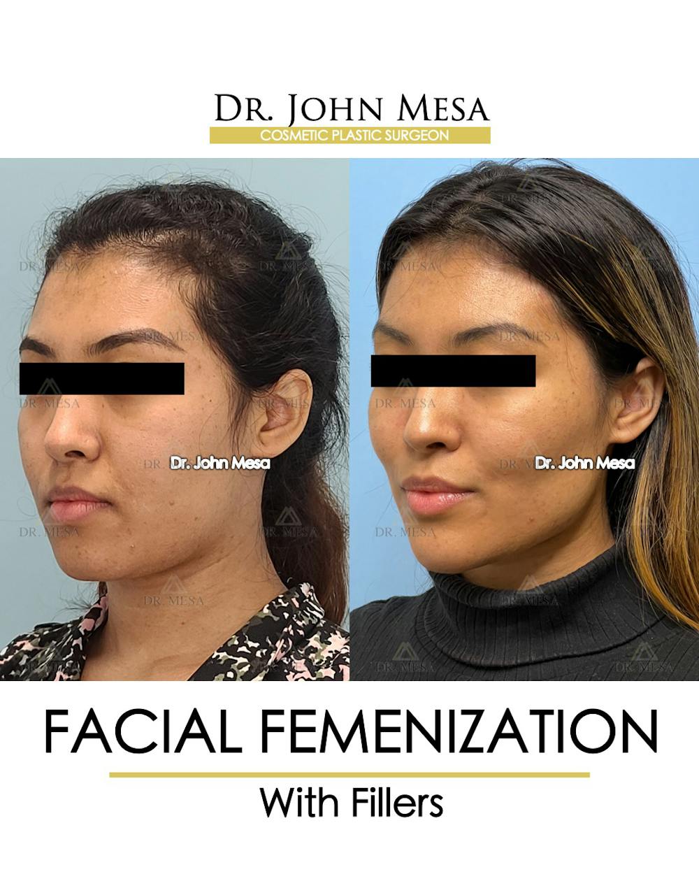 Facial Feminization Before & After Gallery - Patient 148316724 - Image 4